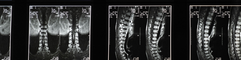 Federal Investigation Into Spine Surgeries Uses Mob Laws to Target Health Care Fraud